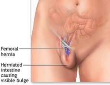 Femoral Hernia Repair