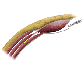 Ventral and Incisional Hernia Repair