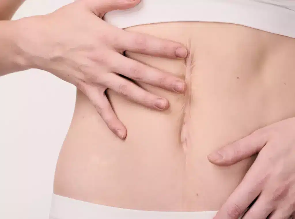 Incisional-Hernia-slider Incisional Hernia slider