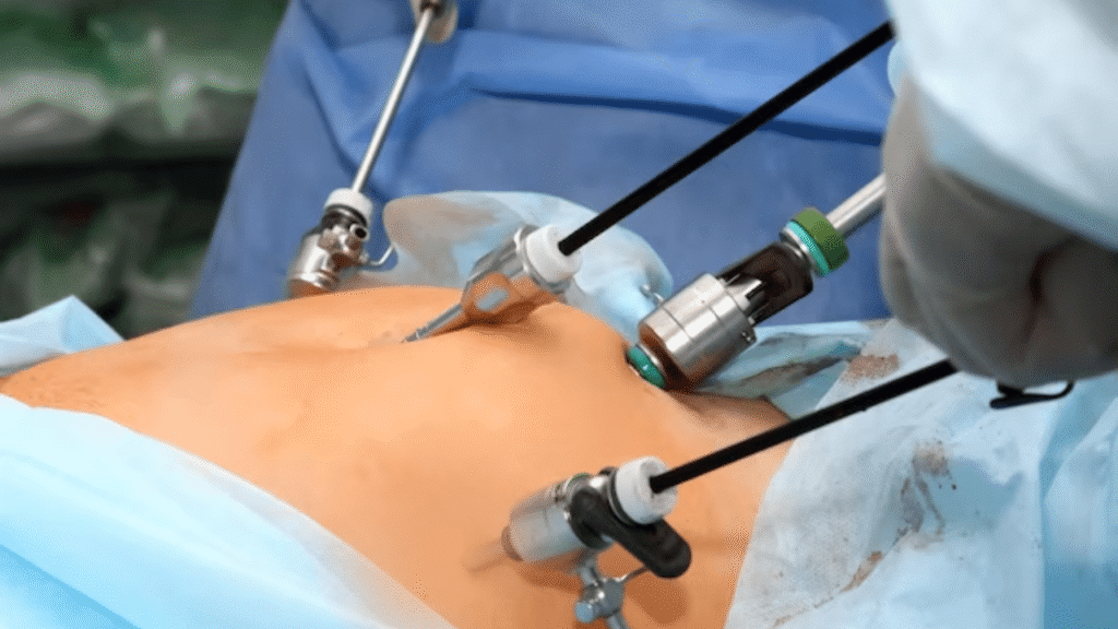 Laparoscopic-Minimally-Invasive-Fibroid-Removal