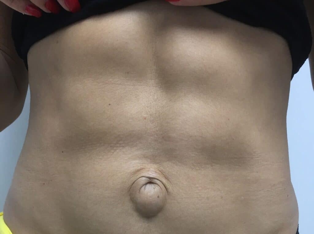 umbilical_hernia_2 umbilical hernia 2
