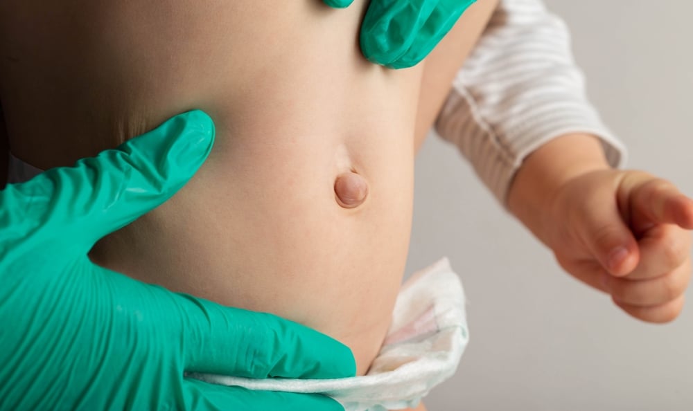 Surgeon examining an abdomen for an umbilical hernia.
